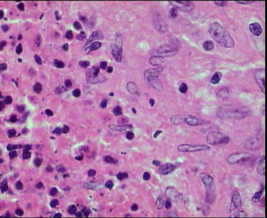 Granulomatosis epitelioide