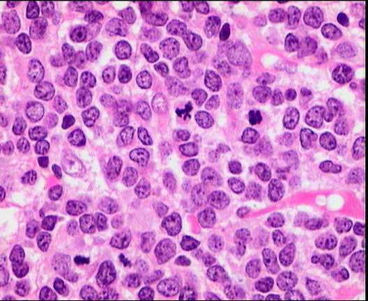 Leucemia aguda linfoide