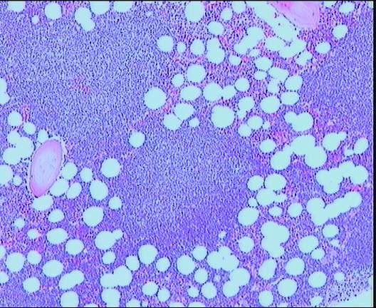 Leucemia linfoice crnica nodular