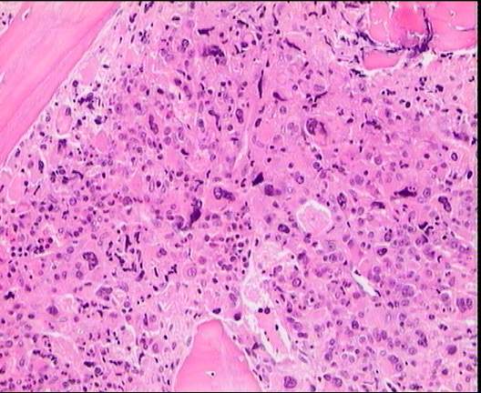Leucemia mieloide aguda megacarioblastica