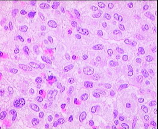 Mastocitosis