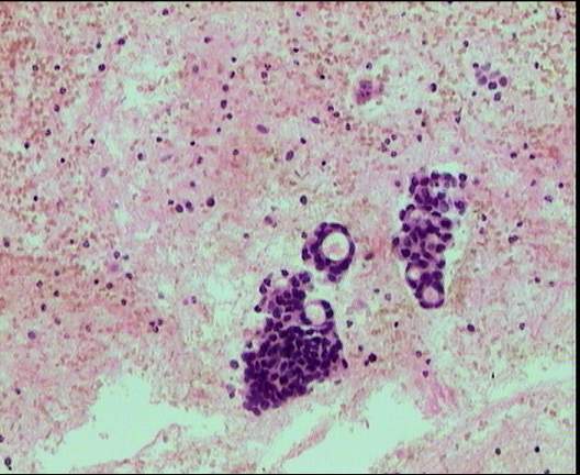 Metstasis de carcinoma