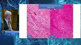 Vídeo Cáncer de Vejiga T1. Aspectos anatomopatológicos recientes y subestadificacion utilizando patología digital