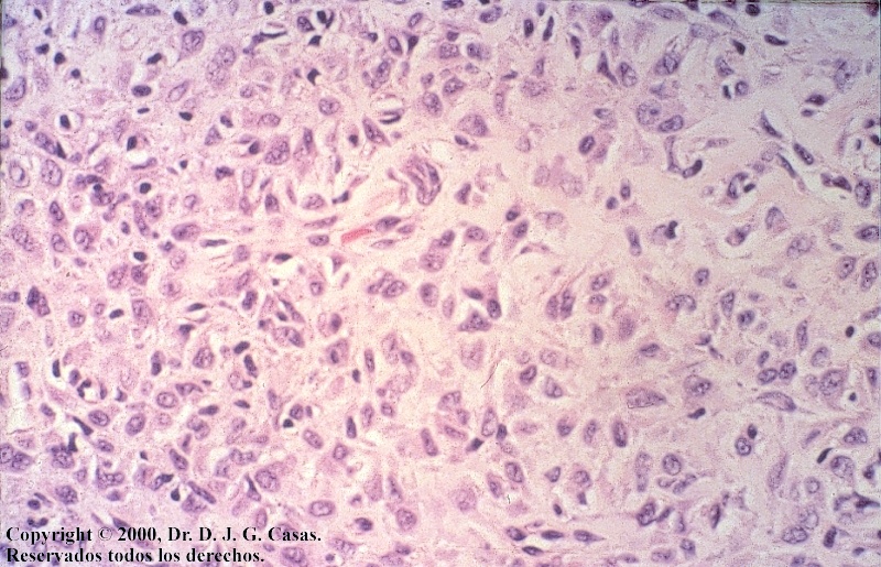 Dermatofibrosarcoma protuberans - Wikipedia