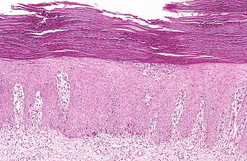Paraqueratosis Paraqueratosis